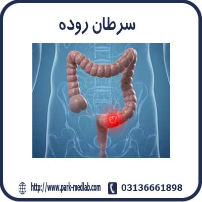 تشخیص جهش های ژنتیکی در سرطان روده
