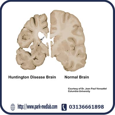 آزمایش بیماری هانتینگتون