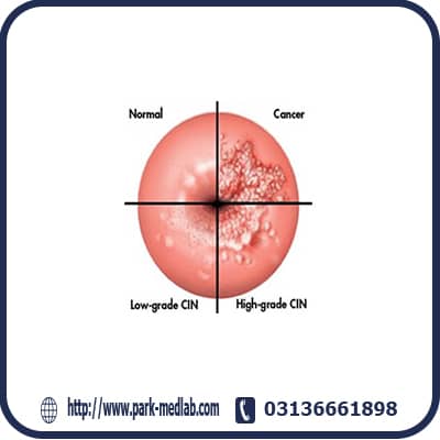 پیشگیری از سرطان دهانه رحم